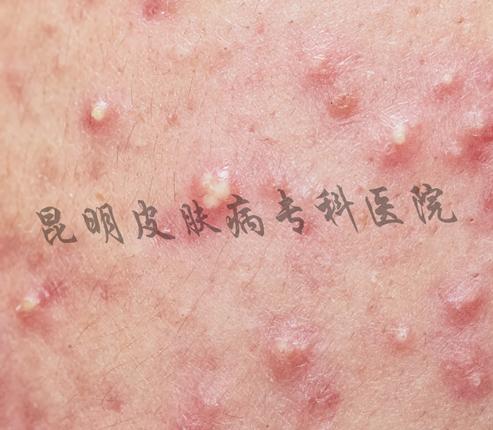 膿包型.png