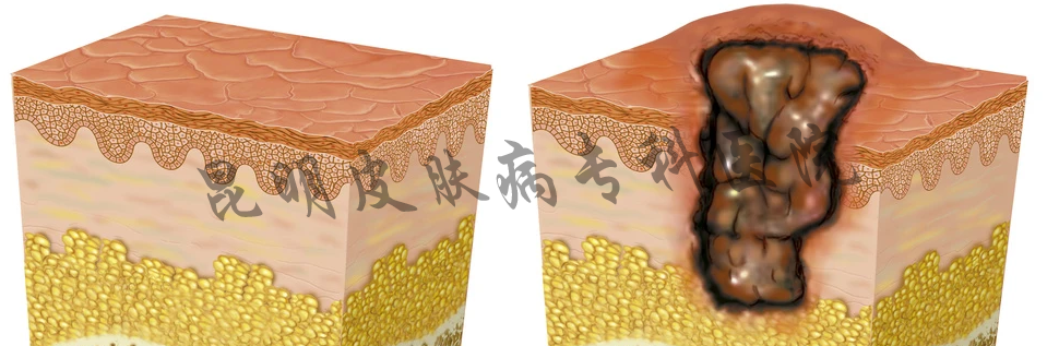 昆明誰家疤痕病醫(yī)院好