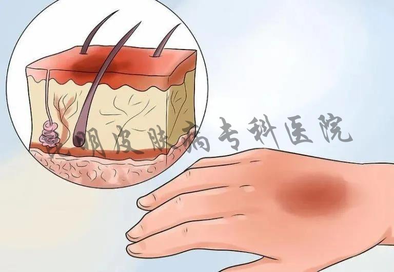 昆明治療疤痕醫(yī)院