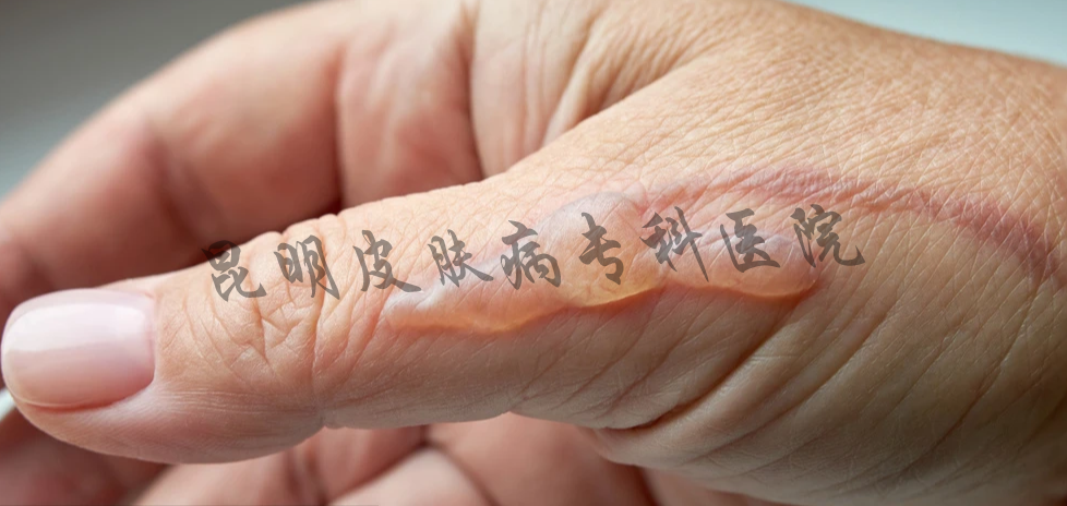 昆明疤痕病醫(yī)院治療醫(yī)院