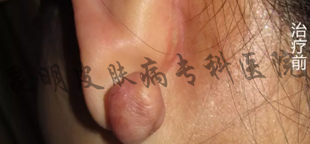 疤痕疙瘩能治療好嗎